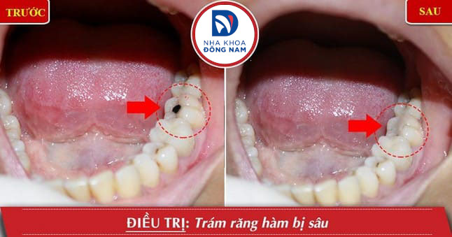 Răng sâu nhẹ có thể điều trị bằng biện pháp trám răng
