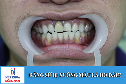 răng sứ bị xuống màu là do đâu
