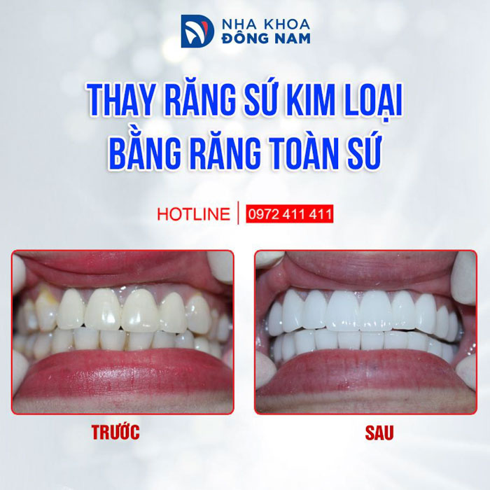 Răng sứ kim loại bị đen viền nướu được thay bằng răng toàn sứ