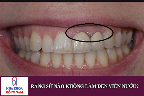 răng sứ nào không làm đen viền nướu