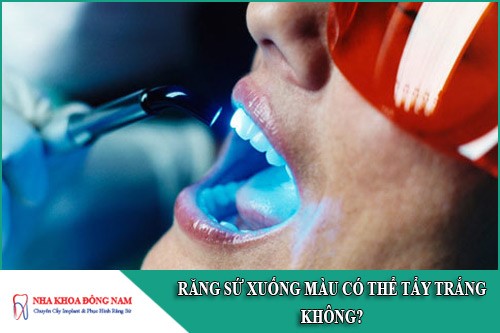 răng sứ xuống màu có thể tẩy trắng được không