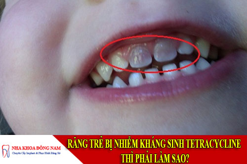 răng trẻ bị nhiễm kháng sinh tetracycline thì phải làm sao