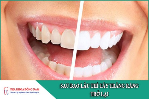 sau bao lâu thì tẩy trắng răng trở lại