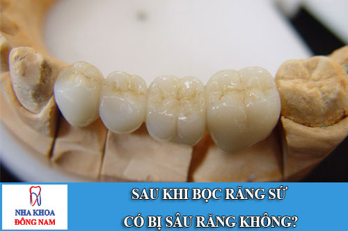 sau khi bọc răng sứ có bị sâu răng không