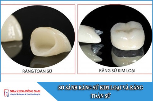 so sánh răng sứ kim loại và răng toàn sứ