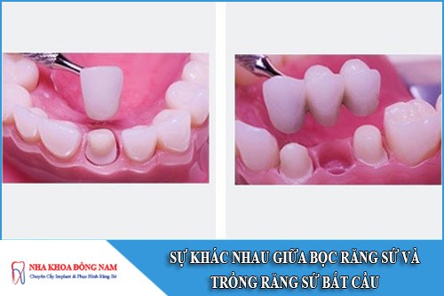 sự khác nhau giữa bọc răng sứ và trồng răng sứ bắt cầu