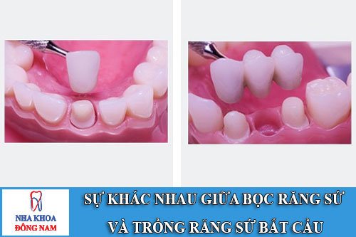 sự khác nhau giữa bọc răng sứ và trồng răng sứ bắt cầu