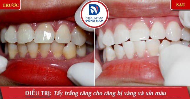 Tẩy trắng răng chỉ cải thiện màu răng bên ngoài chứ không tác động đến tủy răng