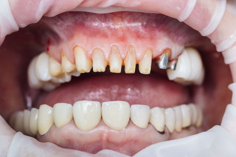 Tháo mão răng sứ không đau khi thực hiện đúng thao tác