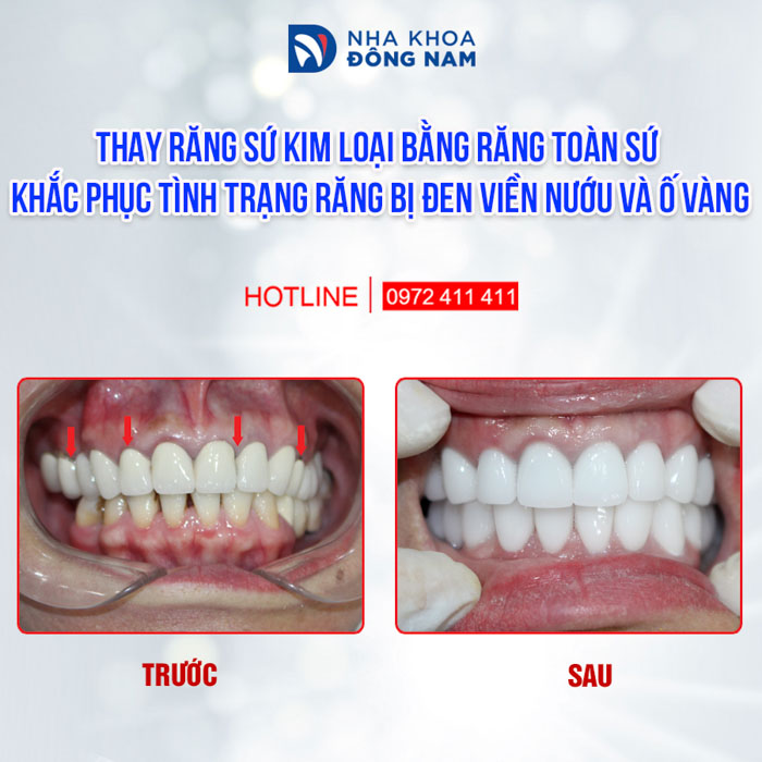 Thay răng sứ kim loại bị đen viền nướu bằng răng toàn sứ