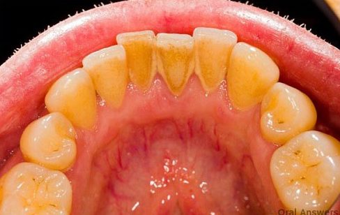 top 10 các vấn đề răng miệng thường gặp 4