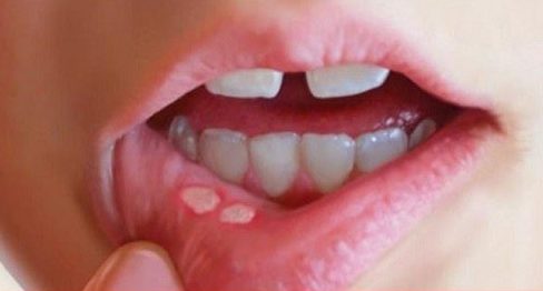 top 10 các vấn đề răng miệng thường gặp 9