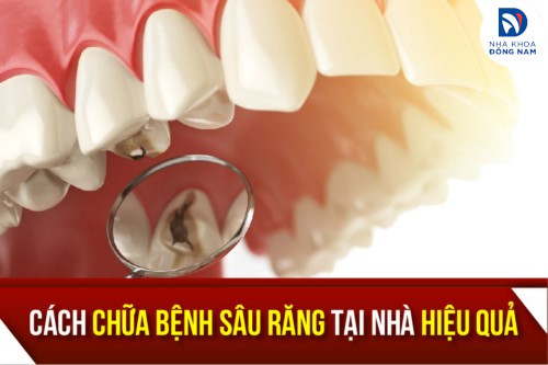 Cách Chữa Bệnh Sâu Răng Tại Nhà Hiệu Quả