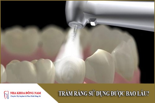 trám răng sử dụng được bao lâu