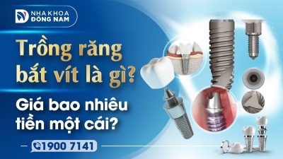 Trồng răng bắt vít là gì