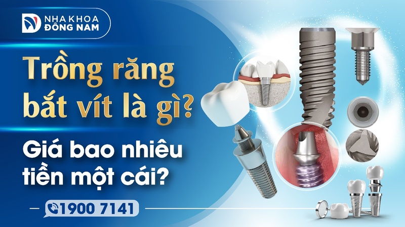 Trồng răng bắt vít là gì