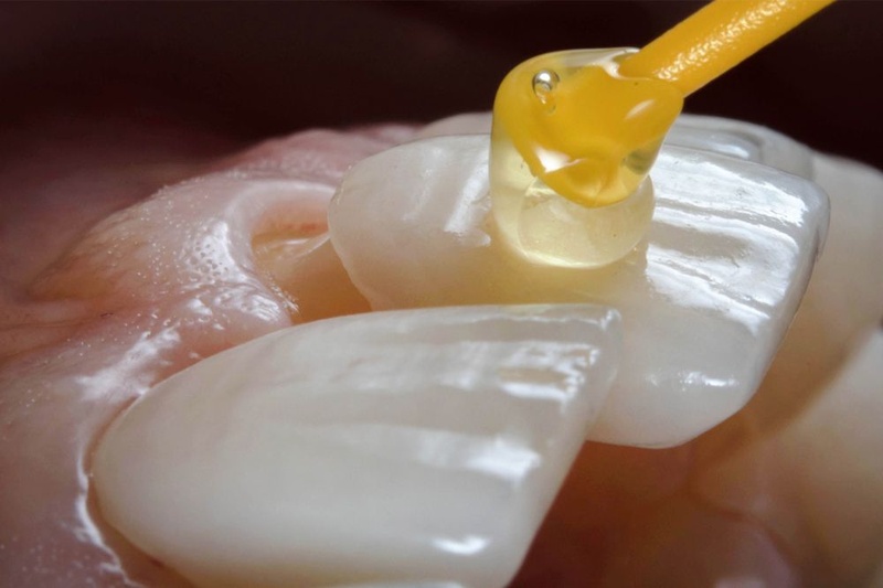 Ưu nhược điểm của bọc răng sứ không mài