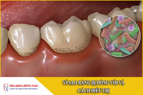 vì sao răng bị đóng vôi và cách điều trị