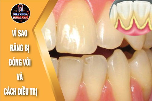 vì sao răng bị đóng vôi và cách điều trị