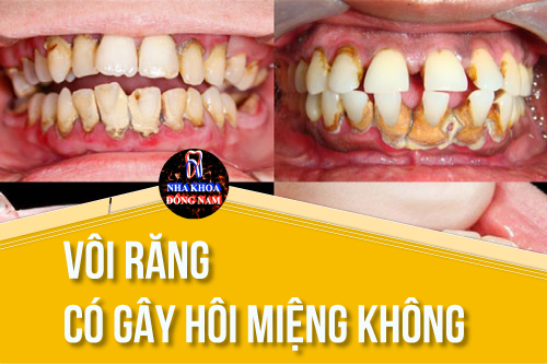 vôi răng có gây hôi miệng không