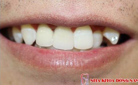 bị hô và răng mọc thừa phía trong thì có bọc sứ được không 3