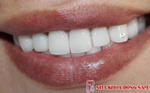 bị hô và răng mọc thừa phía trong thì có bọc sứ được không 4