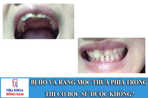bị hô và răng mọc thừa phía trong thì có bọc sứ được không