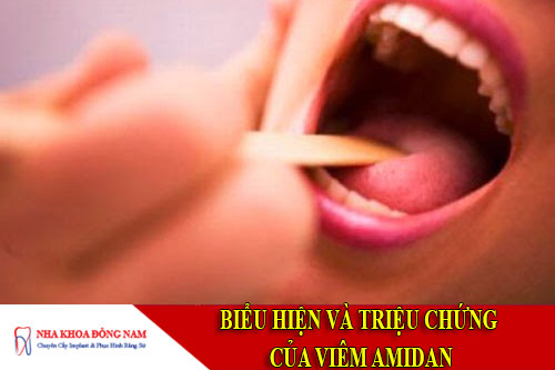 biểu hiện và triệu chứng của viêm amidan