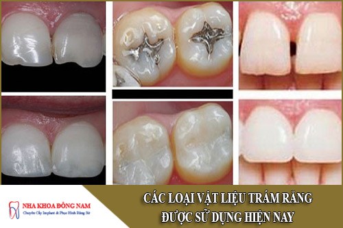 các loại vật liệu trám răng được sử dụng hiện nay