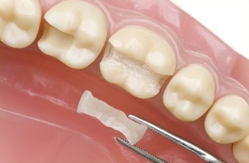 các loại vật liệu trám răng được sử dụng hiện nay 2