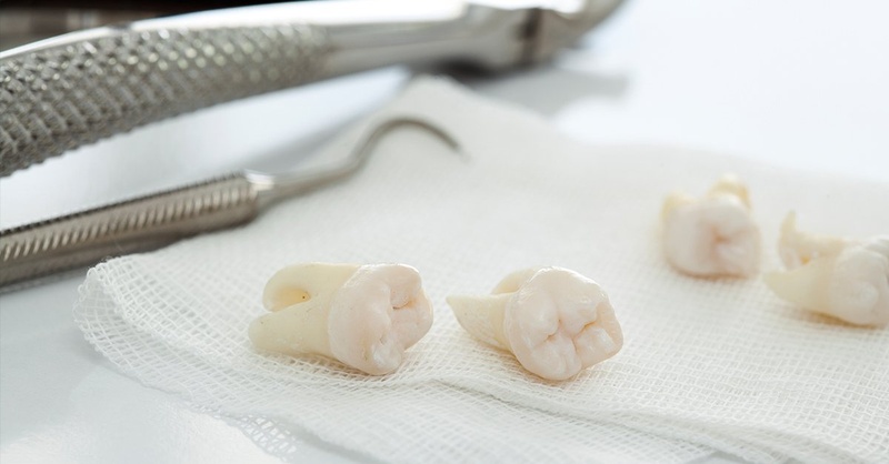 Các trường hợp chống chỉ định thực hiện nhổ răng