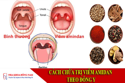 cách chữa trị viêm amidan theo đông y