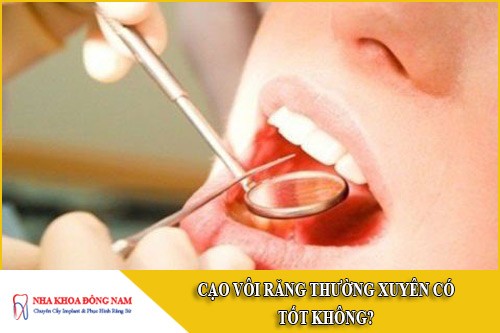 cạo vôi răng thường xuyên có tốt không