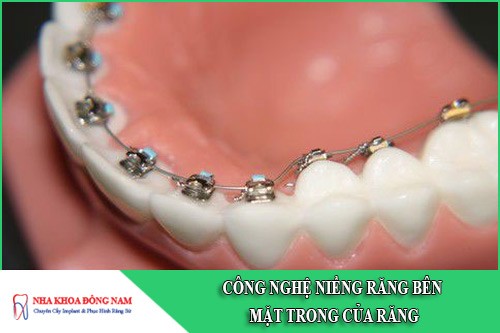công nghệ niềng răng bên mặt trong của răng