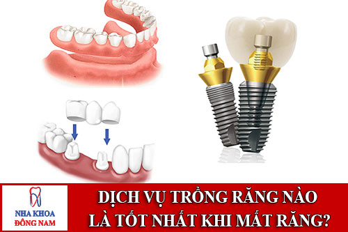 dịch vụ trồng răng nào là tốt nhất khi mất răng?
