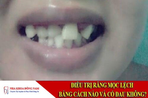điều trị răng mọc lệch bằng cách nào và có đau không