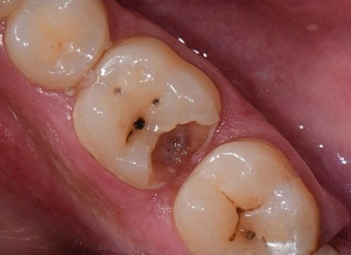 răng bị sâu vỡ mẻ