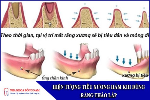 hiện tượng tiêu xương hàm khi dùng răng tháo lắp