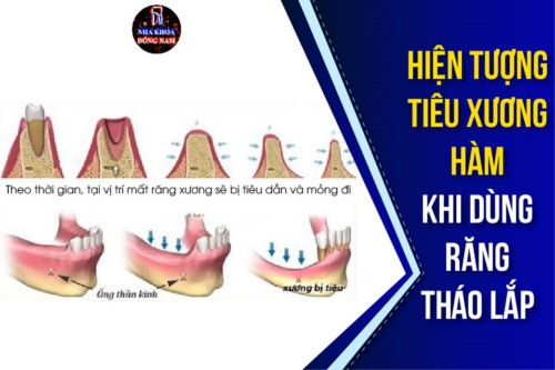 hiện tượng tiêu xương hàm khi dùng răng tháo lắp