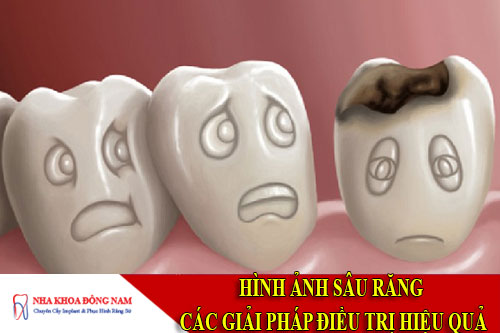 hình ảnh sâu răng & các giải pháp điều trị hiệu quả