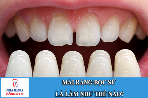mài răng bọc sứ là làm như thế nào