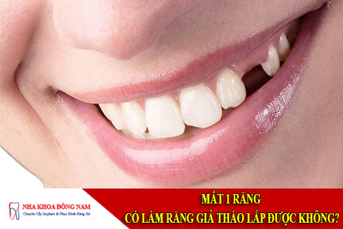 mất 1 răng có làm răng giả tháo lắp được không