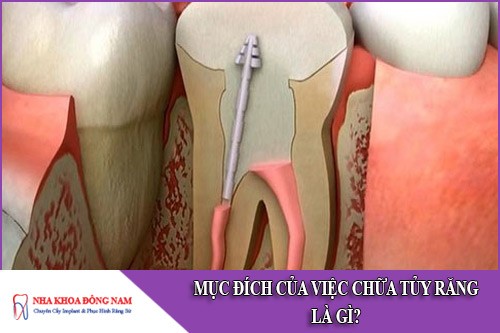 mục đích của việc chữa tủy răng là gì