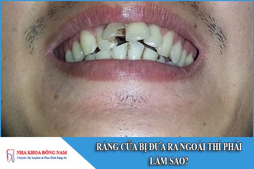 răng cửa bị đưa ra ngoài thì phải làm sao