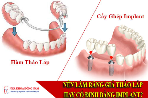 nên làm răng giả tháo lắp hay cố định bằng implant