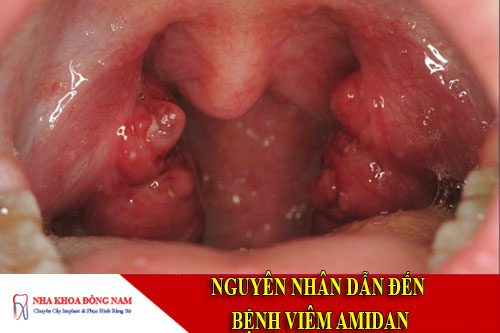 nguyên nhân dẫn đến bệnh viêm amidan