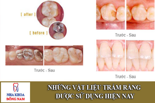 những vật liệu trám răng được sử dụng hiện nay