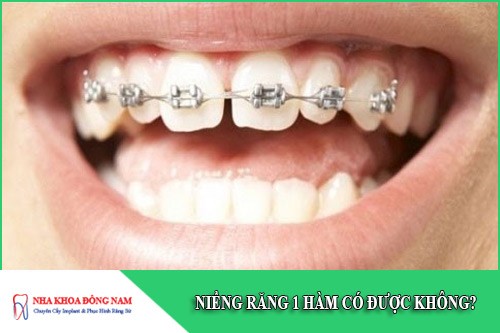 niềng răng 1 hàm có được không