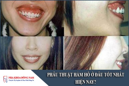 phẫu thuật hàm hô ở đâu tốt nhất hiện nay