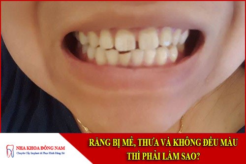 răng bị mẻ thưa và không đều màu thì phải làm sao